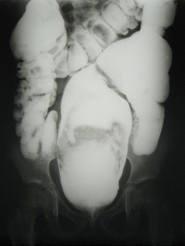 signs of bowel obstruction in dogs what are signs of bowel obstruction in dogs signs of bowel obstruction in dogs what are signs of bowel obstruction in dogs