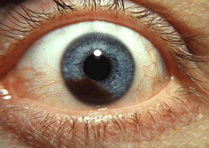 Intraocular Melanoma