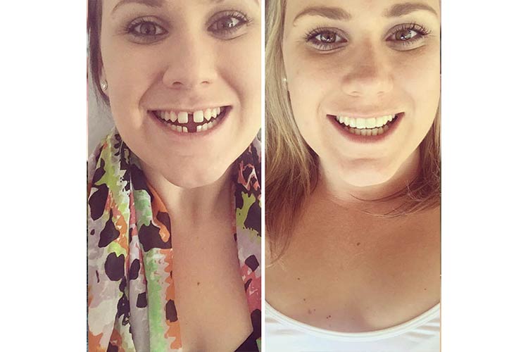 Closing the gap on the perfect smile