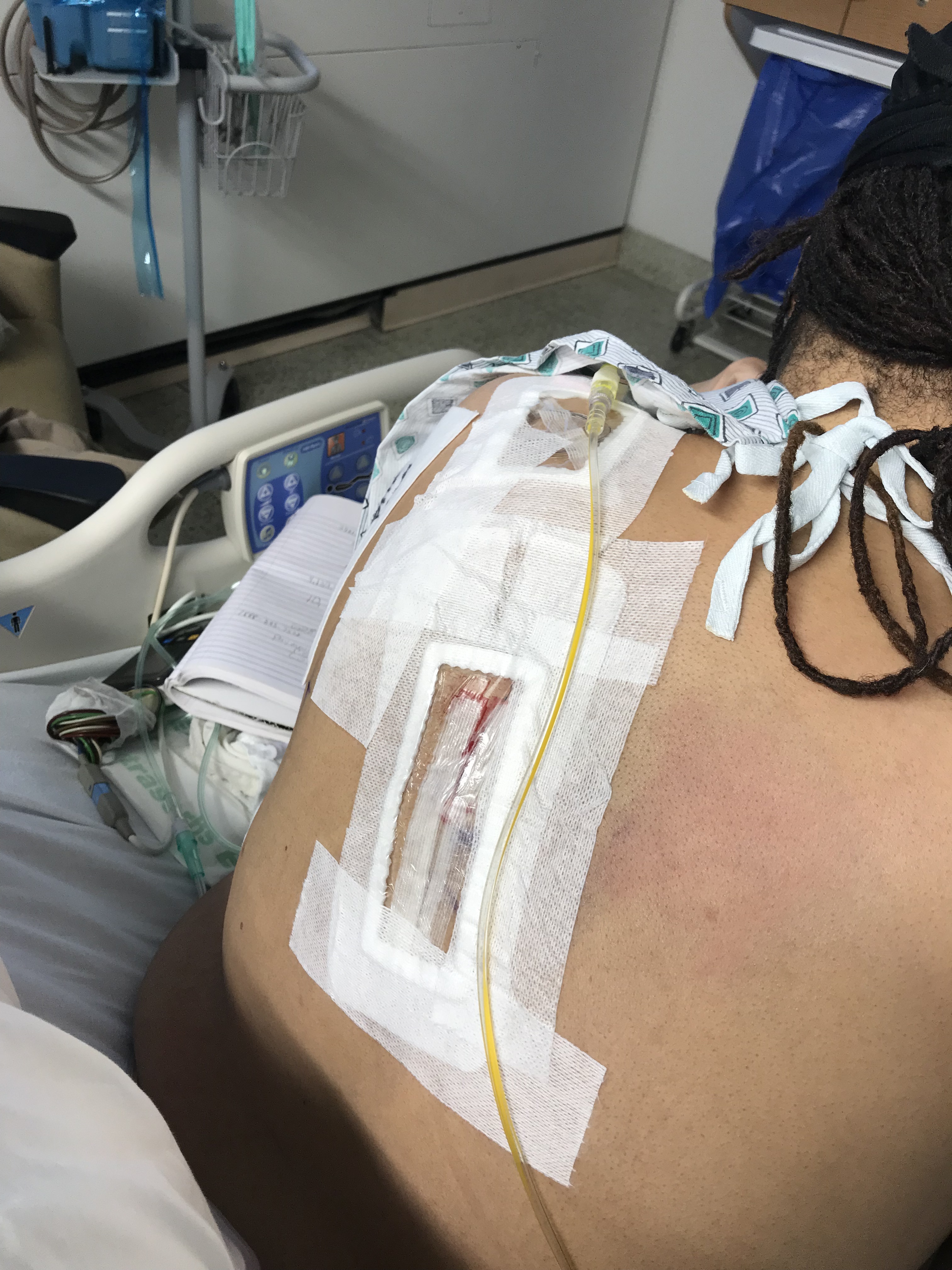 Jan 15, 2019 broken ribs