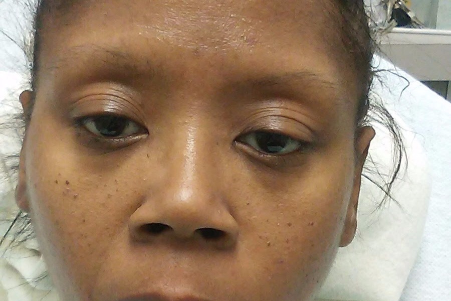 Hemangioendothelioma