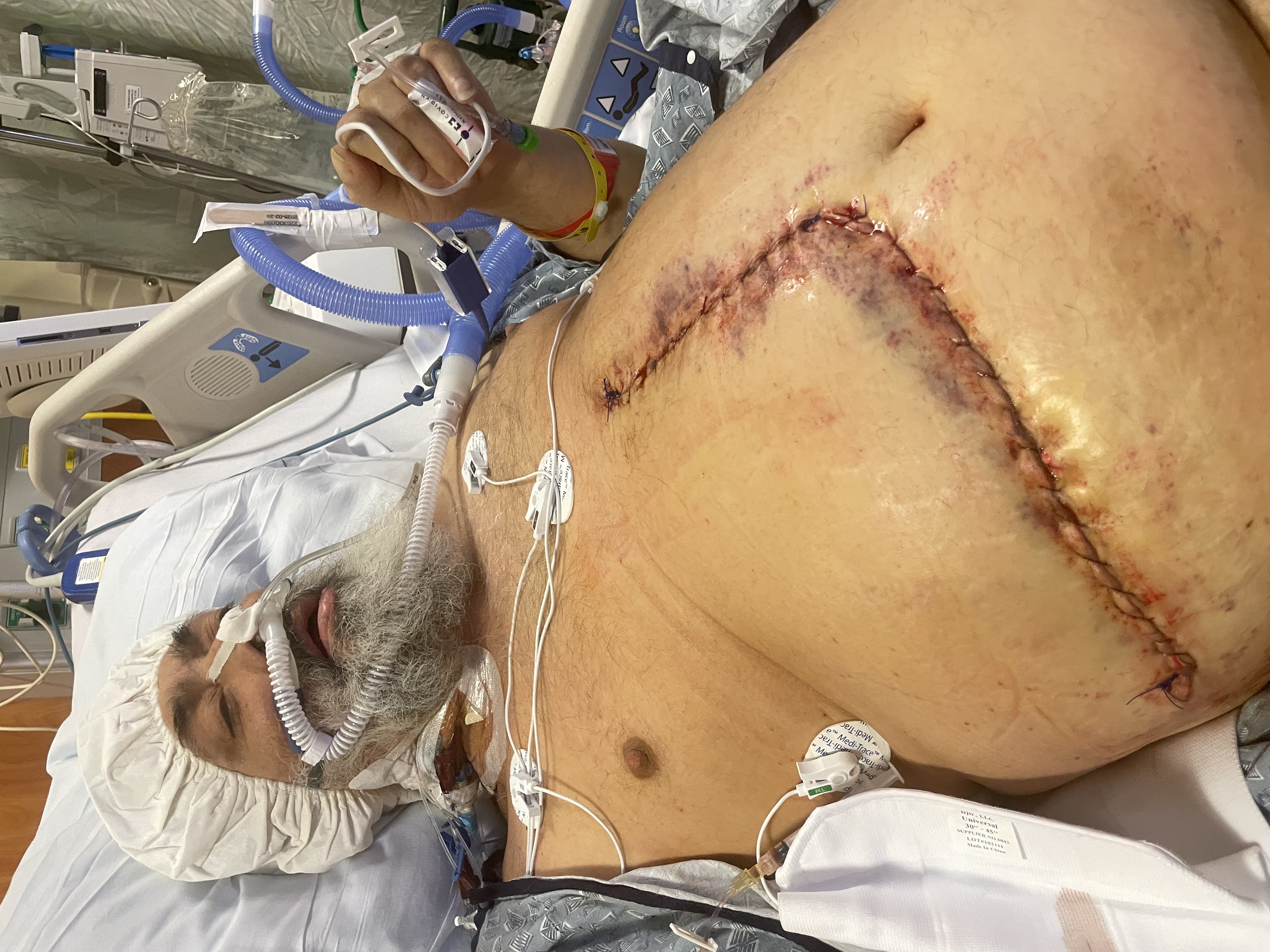 After Liver Transplant Surgery