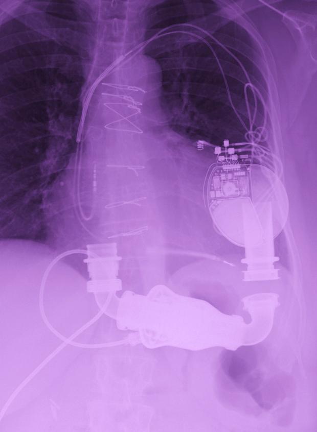 This is the Heart Pump inside