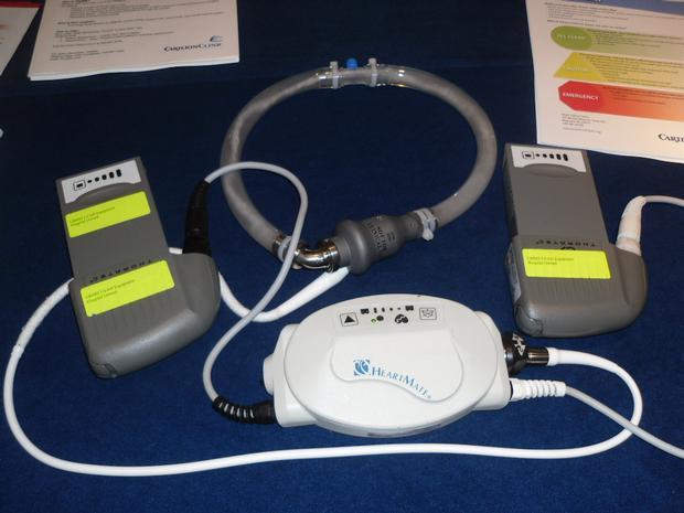 Picture of Heart Pump inside mom