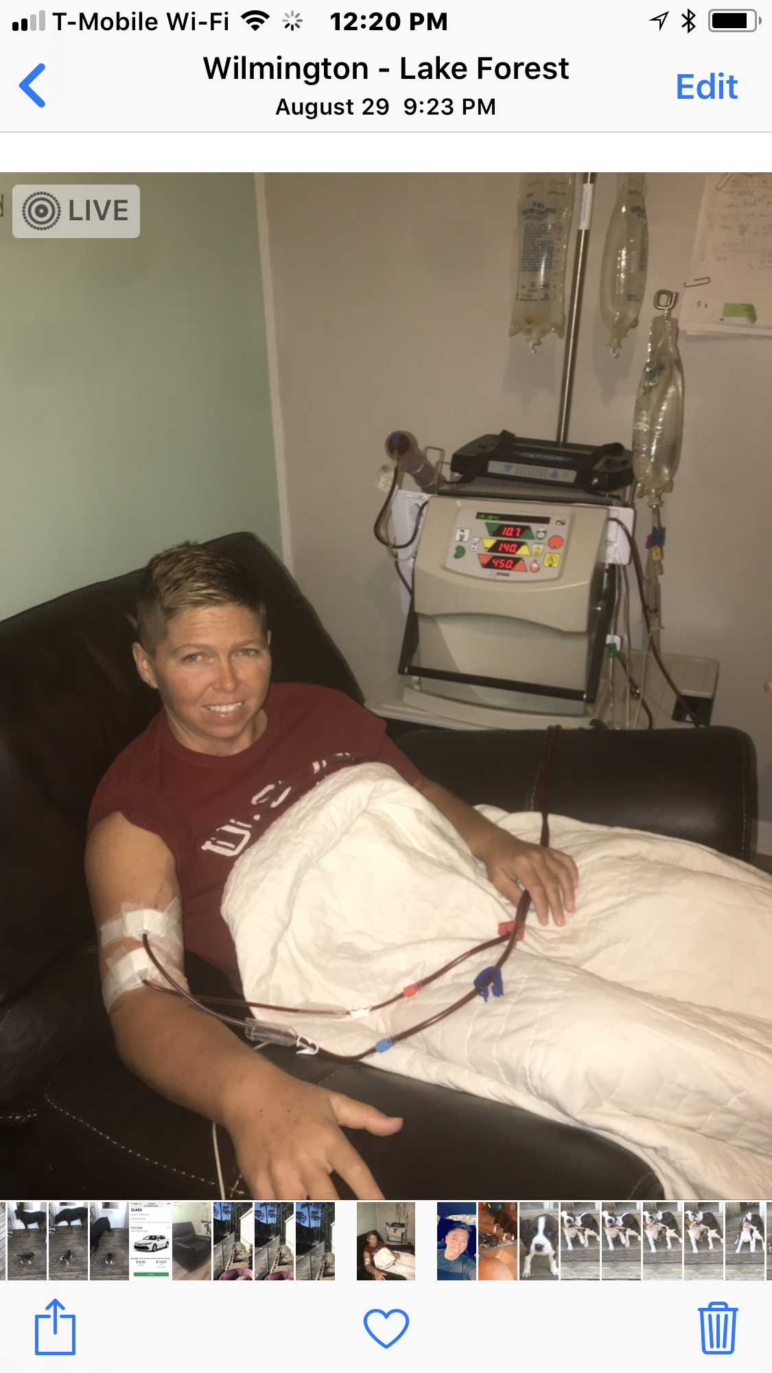 dialysis and 1st transplant