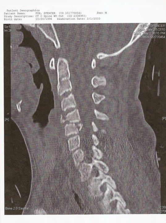 Spencer's Hospital Stay - 109 Days!