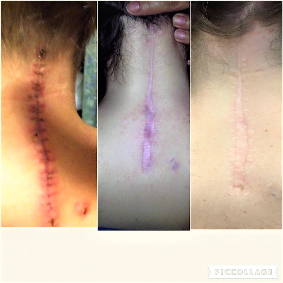 Lauren's Road to Recovery