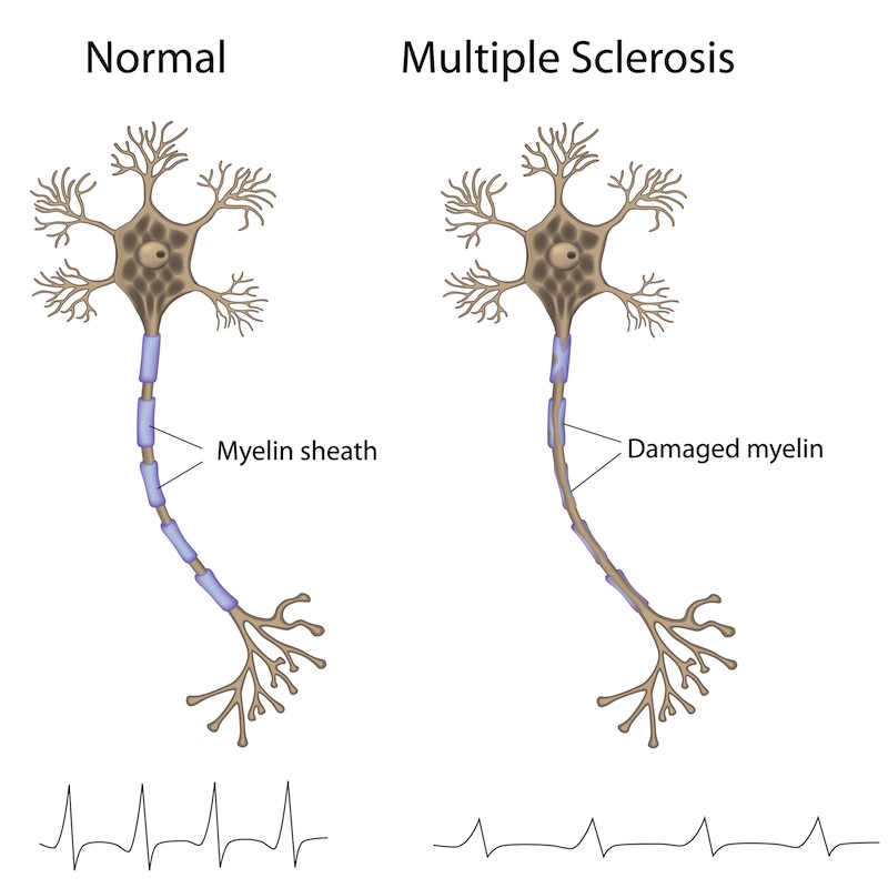 How MS damages our nerves and brain cells and how stem cell treatment repairs this damage