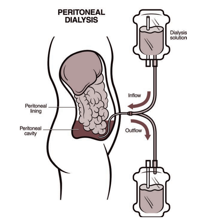 Dialysis Diagrams (Click To See More)