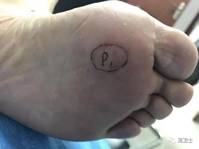 跖痛症无创治疗案例 孙女士49岁 侯佳琪技师