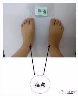 距骨骨软骨损伤解决案例 胡女士28岁 崔书琛技师
