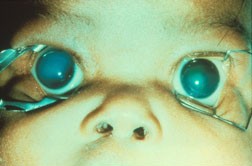 Glaucoma Examination Child going through a Glaucoma examination