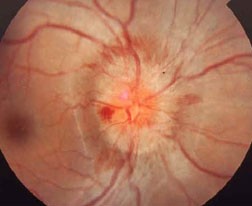 Optic Nerve Swelling Optic Neuritis FBQA