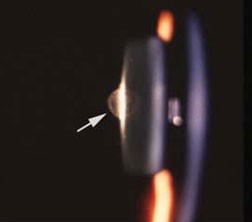 Posterior polar cataract Posterior polar cataract