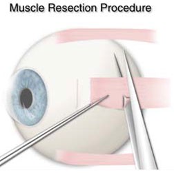 Muscle Resection Diagram Muscle Resection Diagram
