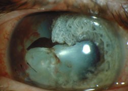 traumatic cataract a traumatic cataract results when either a blunt or penetrating object damages the lens