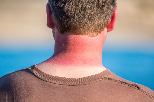 Sunburn Sunburn