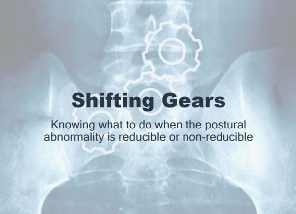 Shifting Gears -Knowing what to do when the postural abnormality is reducible or non-reducible Shifting Gears -Knowing what to do when the postural abnormality is reducible or non-reducible