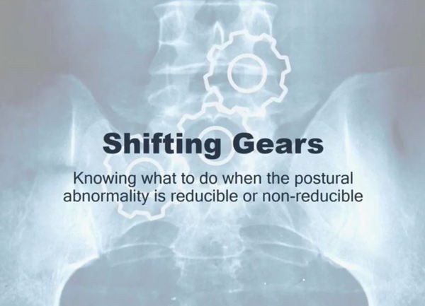 Shifting Gears -Knowing what to do when the postural abnormality is reducible or non-reducible