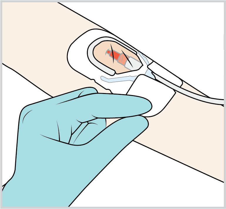 Peripheral Intravenous Catheter (PIV) - Medline