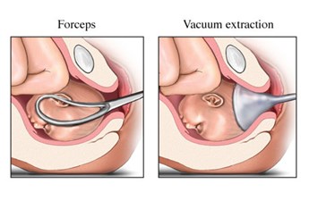 ppt operative vaginal delivery powerpoint presentation free to vacuum delivery