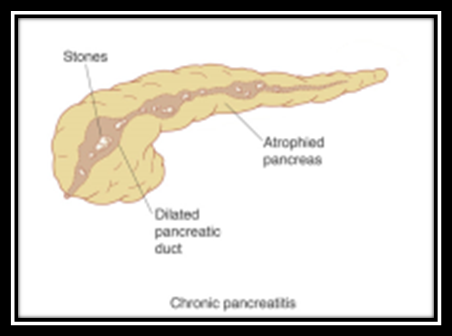 Ppt Chronic Pancreatitis Causes Symptoms Diagnosis And Treatment Of Chronic Pancreatitis 1 Powerpoint Presentation Free To Download Id 60f8 Mmzmy