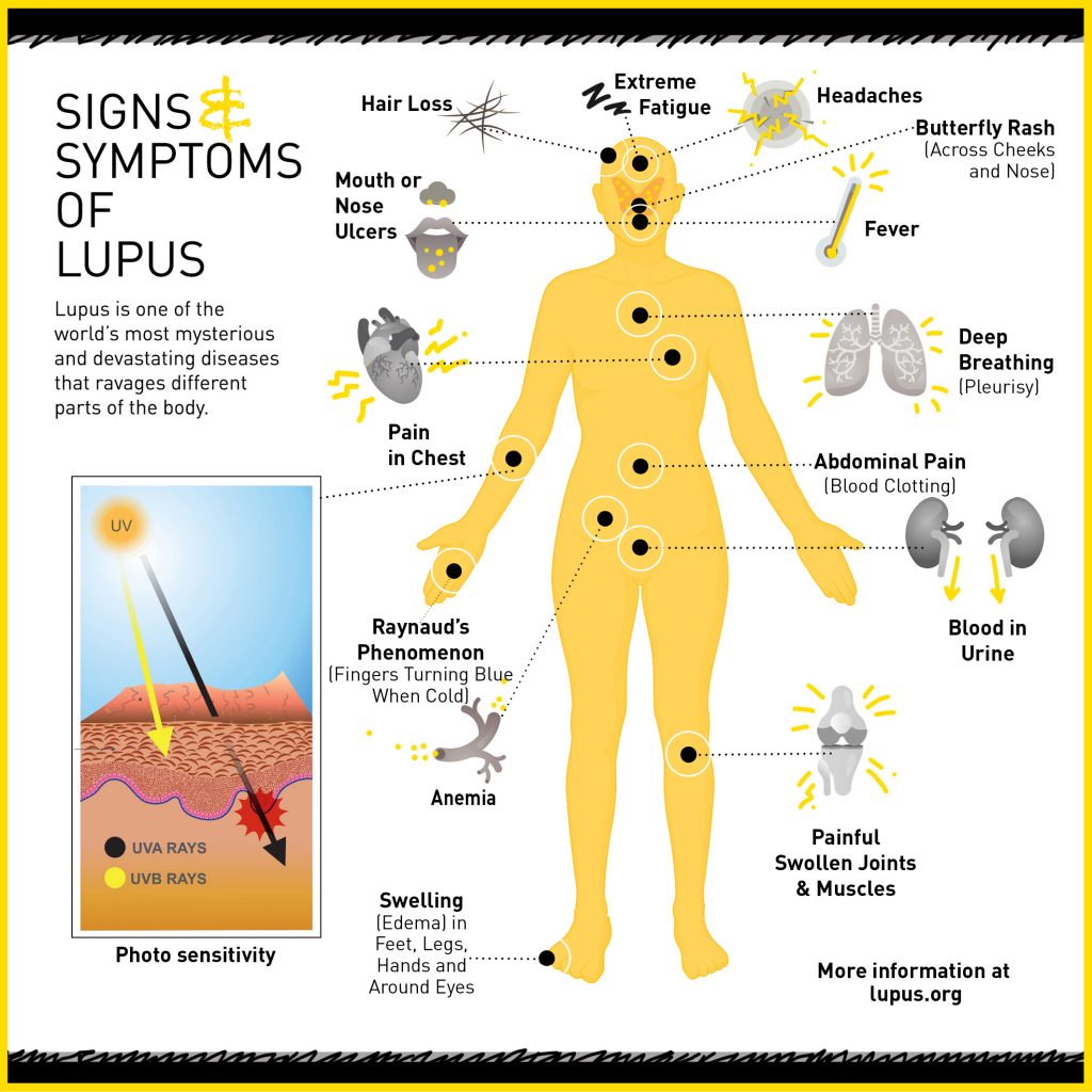 Lupus Fighting an invisible monster HudsonAlpha Institute for Biotechnology