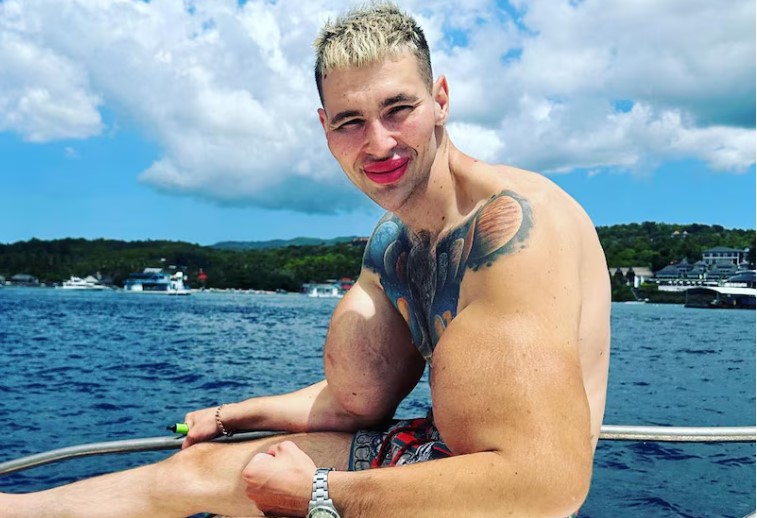 “Popeye ruso” podría perder los brazos tras inyectarse aceite y vaselina