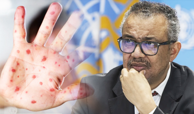 OMS: Muertes por sarampión bajan en un 88% pero contagios están en aumento