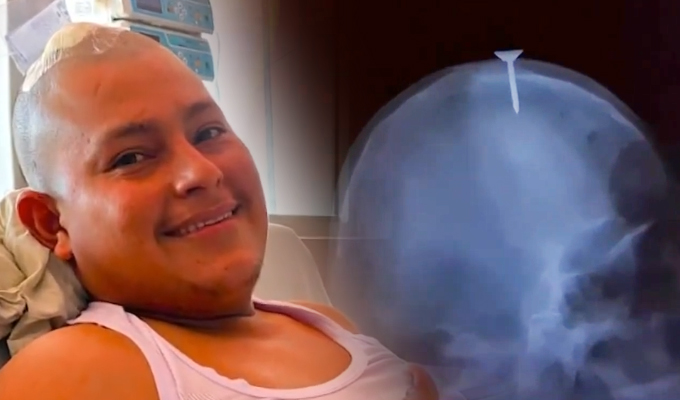 Obrero se salva de milagro luego que clavo se incrustó en su cabeza en Iquitos