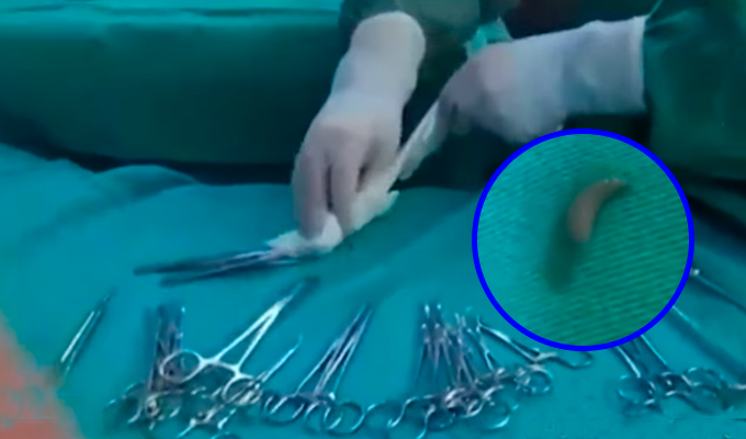 Huancayo: Larvas caen en mesa de operaciones en plena cirugía y reavivan alarma en hospital