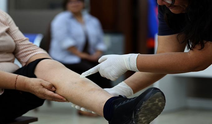 EsSalud advierte incremento de síntomas de várices en verano y brinda recomendaciones para cuidar la salud de las piernas