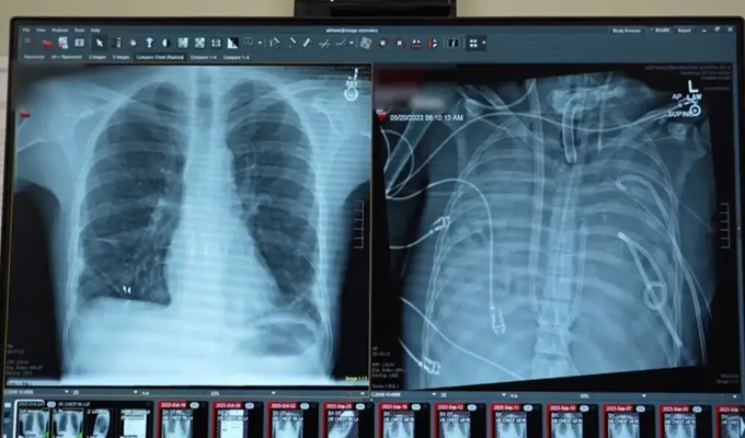 Hombre vivió 48 horas sin pulmones mientras esperaba un trasplante en EEUU