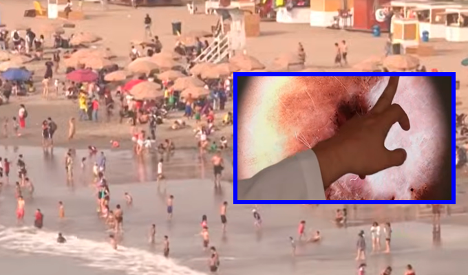 Radiación UV en playas de Lima alcanza niveles críticos y alertan por cáncer de piel
