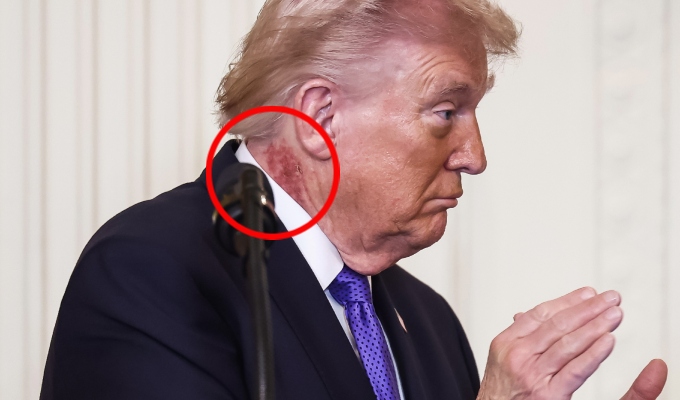 ¿Qué le pasó a Trump? Captan al presidente con sarpullido durante ceremonia oficial