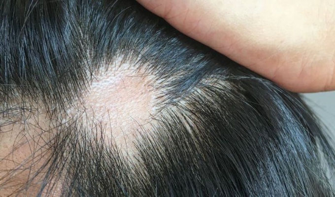El estrés prolongado puede alterar el ciclo natural del cabello