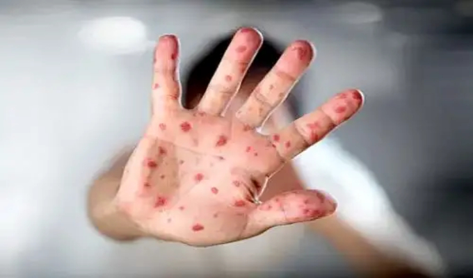 Alerta en Lima: reportan contagios de virus Coxsackie en escolares