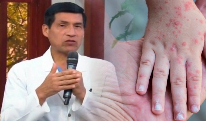 Experto en salud pública descarta epidemia de virus Coxsackie en el Perú