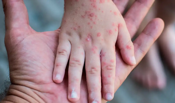 Virus Coxsackie: sepa cómo se contagia y cómo prevenir la enfermedad de manos, pies y boca
