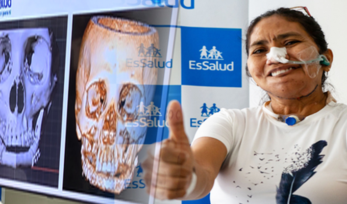 Médicos de EsSalud reconstruyen rostro de paciente con hueso y venas de su propia pierna