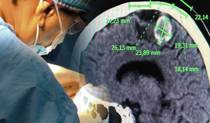 Hospital Santa Rosa de Pueblo Libre realiza con éxito su primera craneotomía y extirpó lesión cerebral a paciente de 57 años