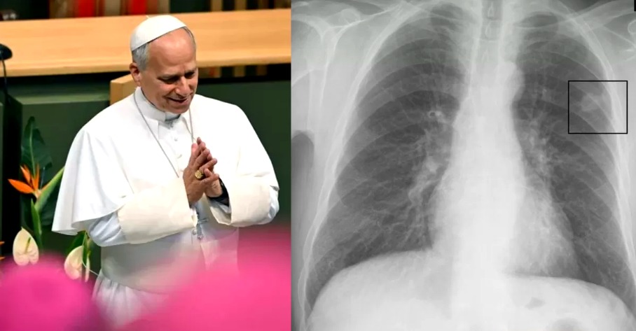 Papa León XIV: ¿podrá continuar con sus viajes tras la cirugía pulmonar?