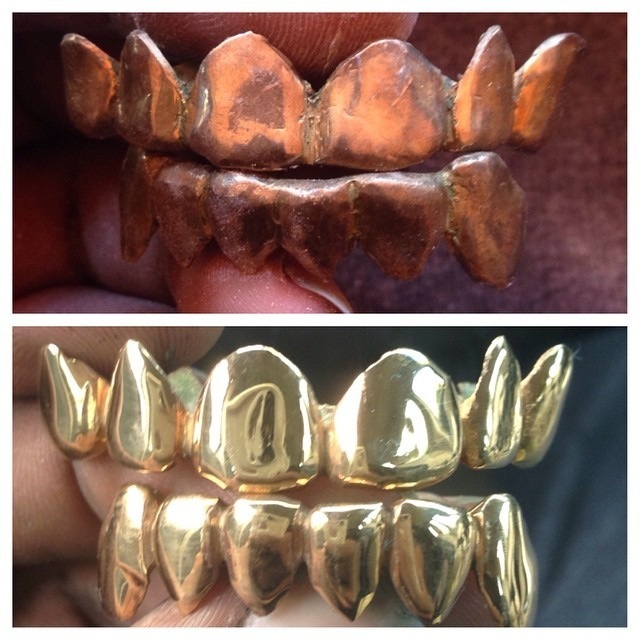 Resurfacing Grillz