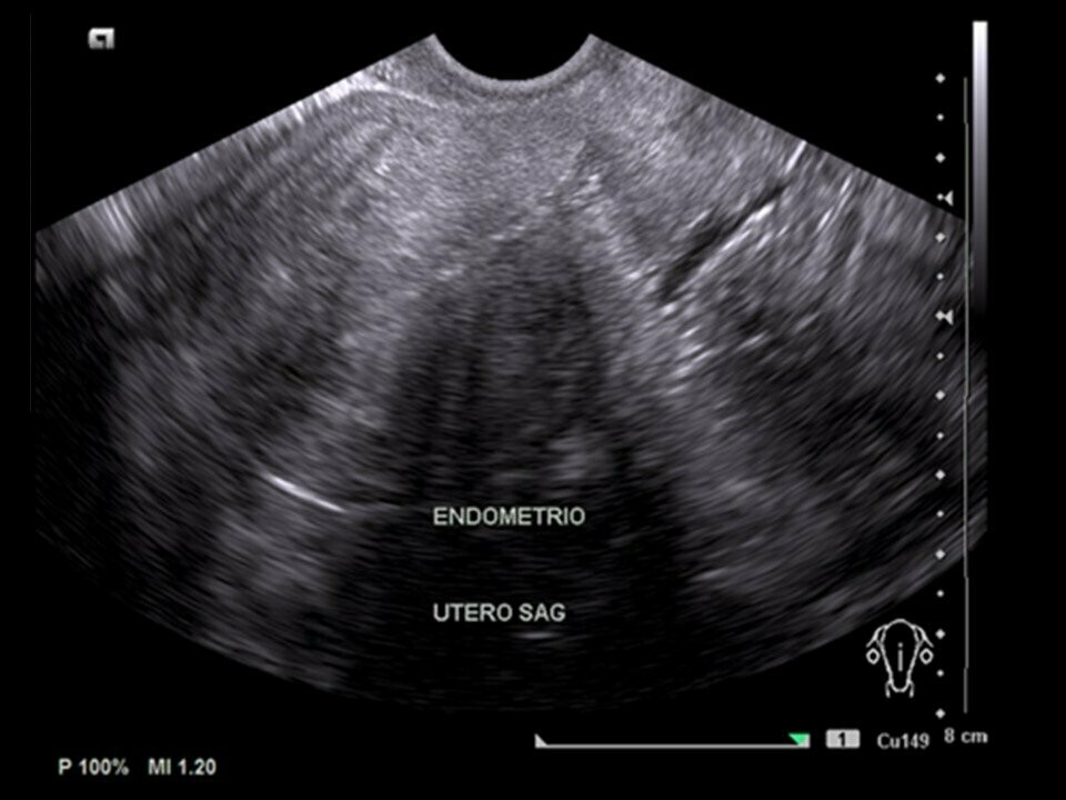 El Ultrasonido Transvaginal Y Sus Ventajas Sobre Otros Ex Menes My