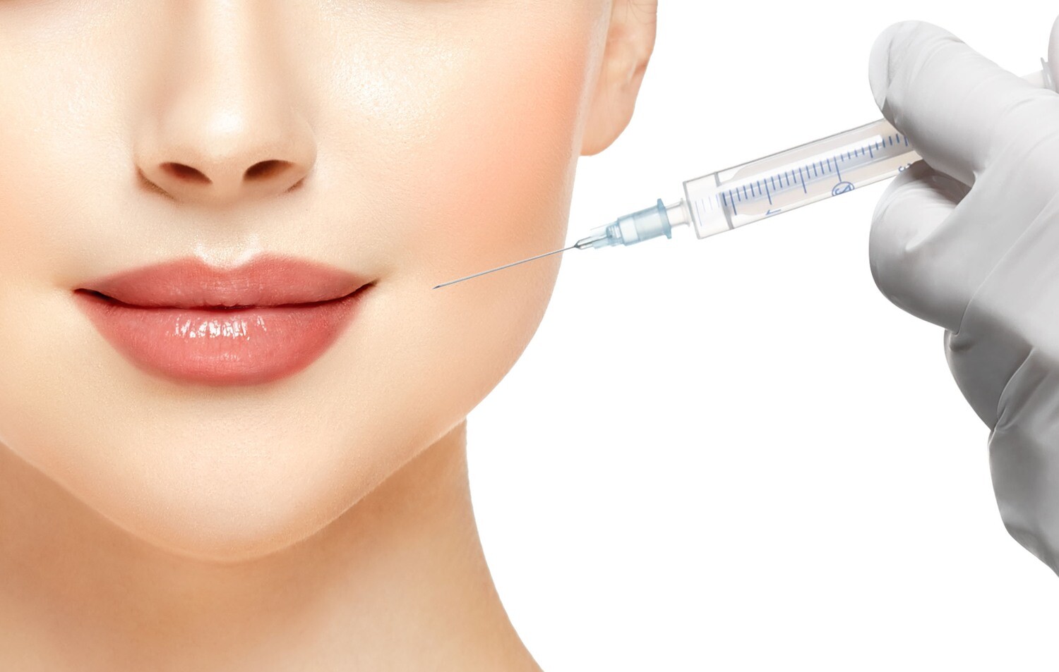 One syringe of filler