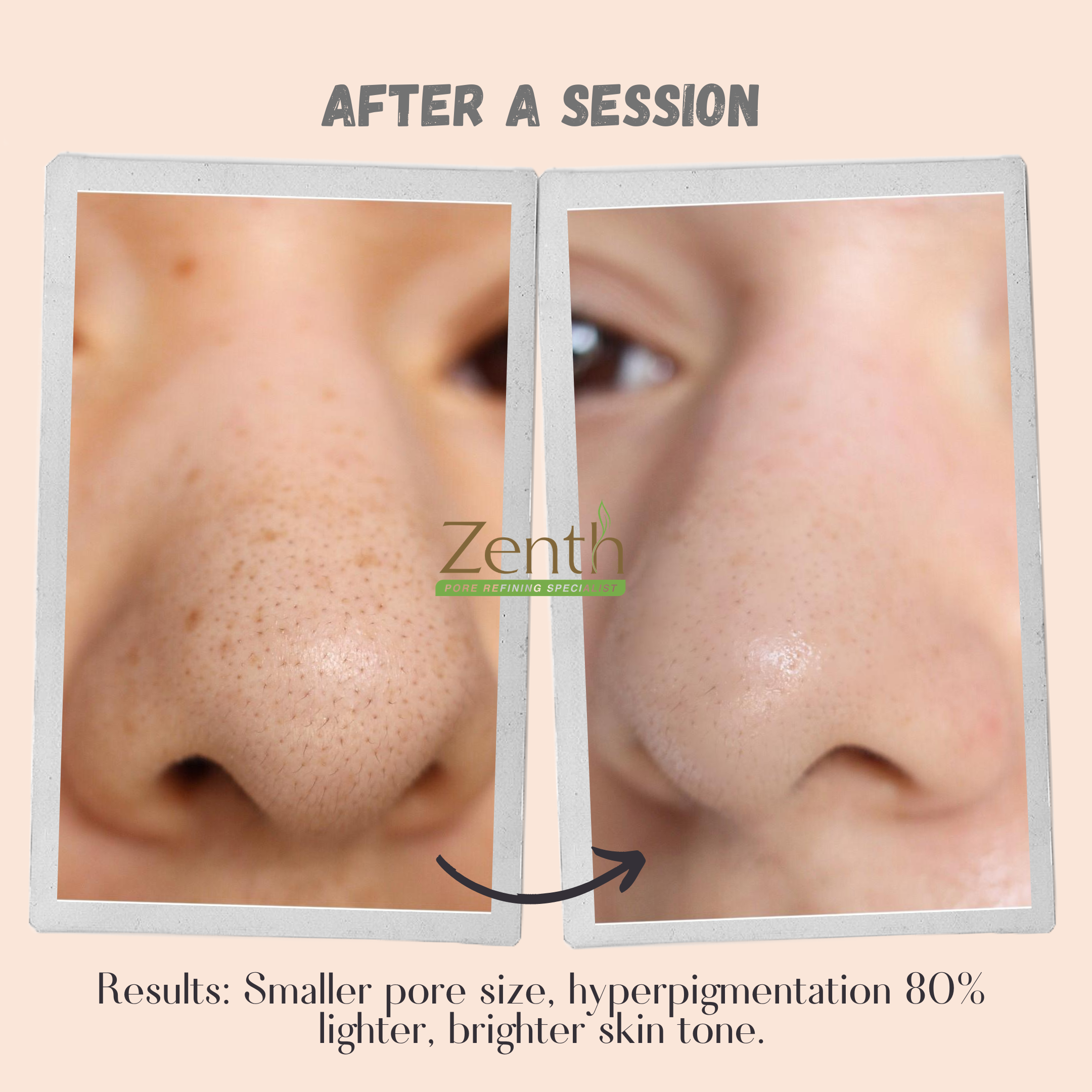 PORE REFINER KIT (Recovery Set)