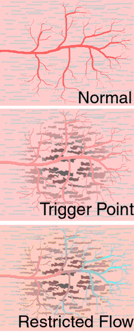 Trigger-Point