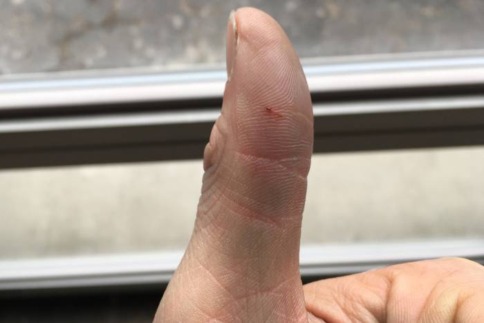 Slashed thumb