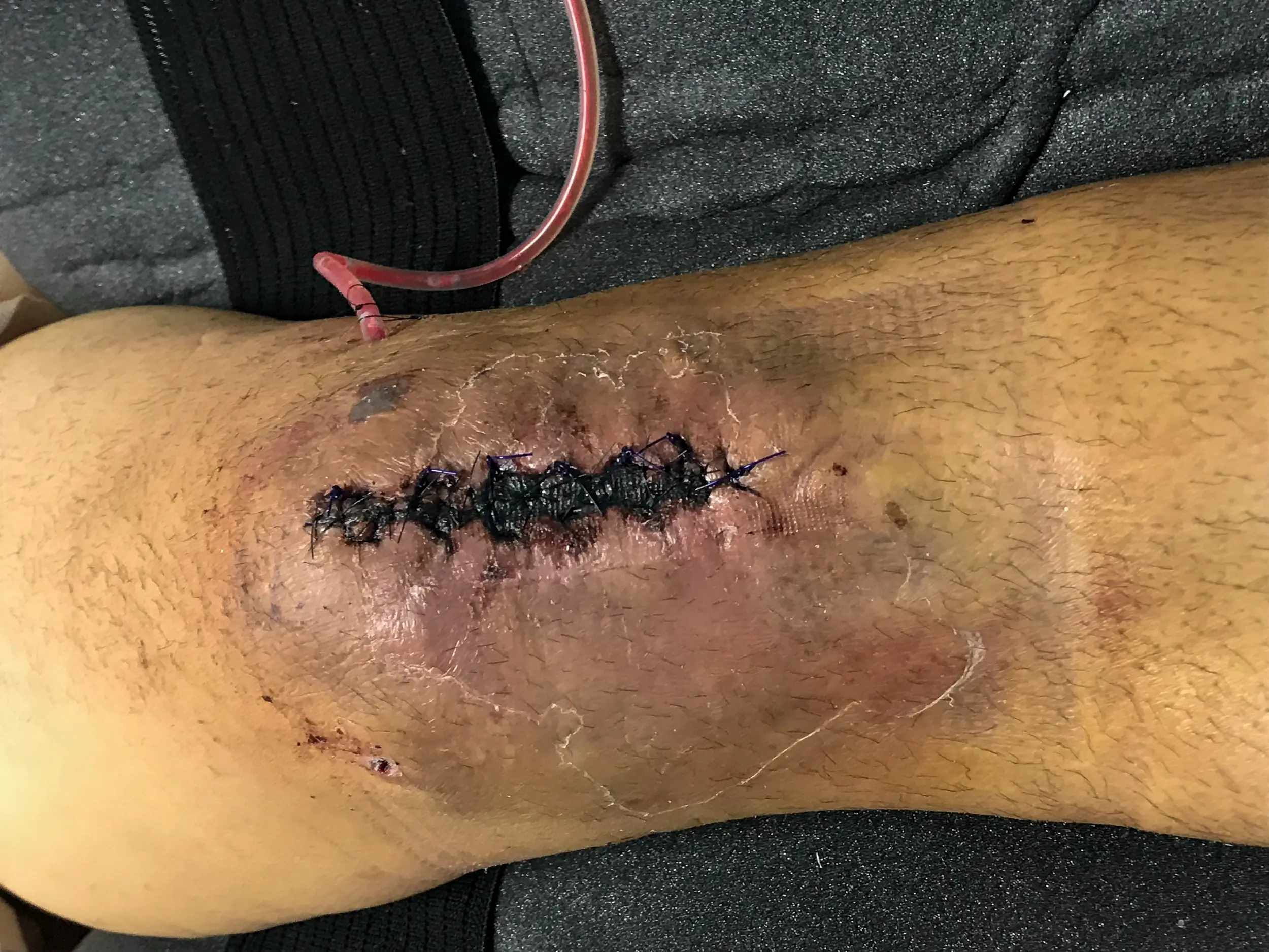 Seiji Ishii's knee injury