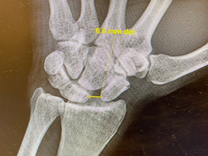 x-ray of broken wrist